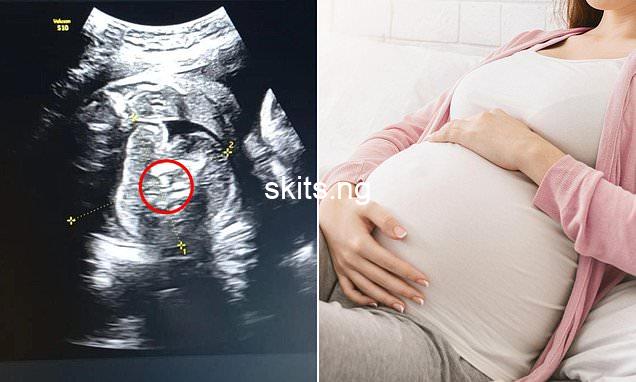 Baby boy found to have two fetuses growing inside his tummy